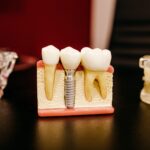 Zubni implantati