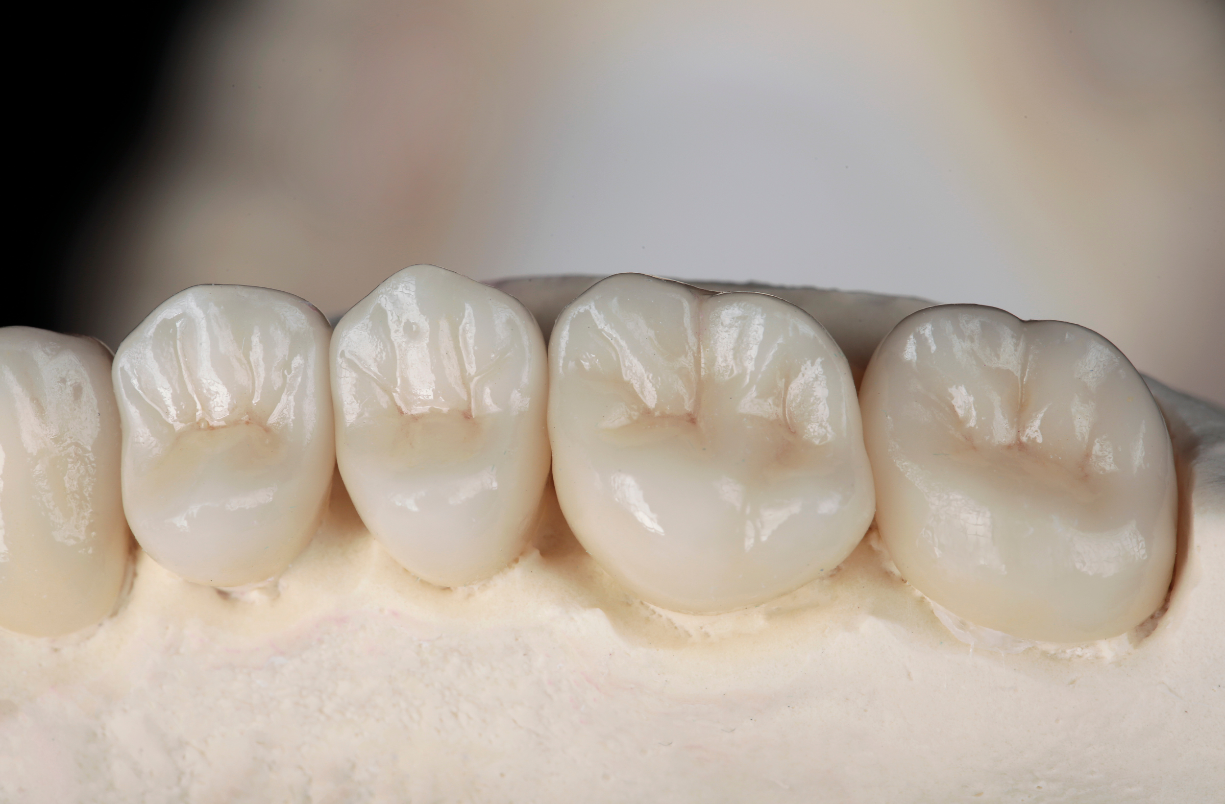 What Are Crowns and Bridges?