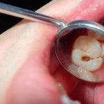 Endodoncija – Što je i čime se bavi?