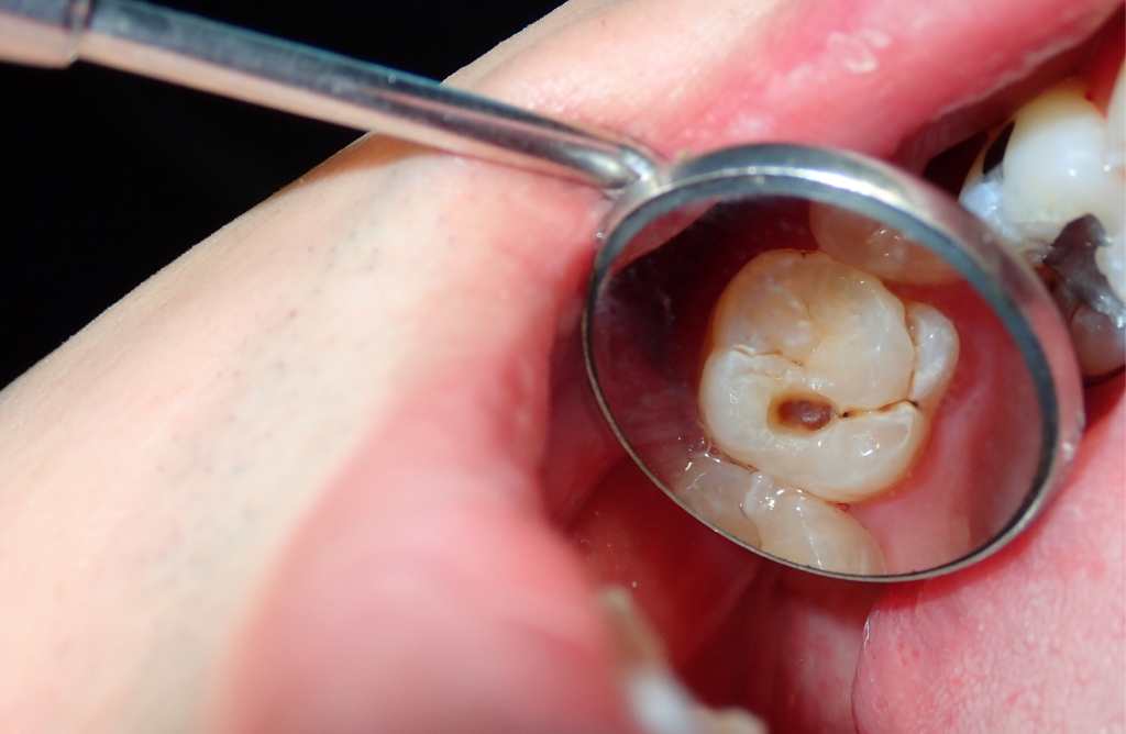 Endodoncija – Što je i čime se bavi?