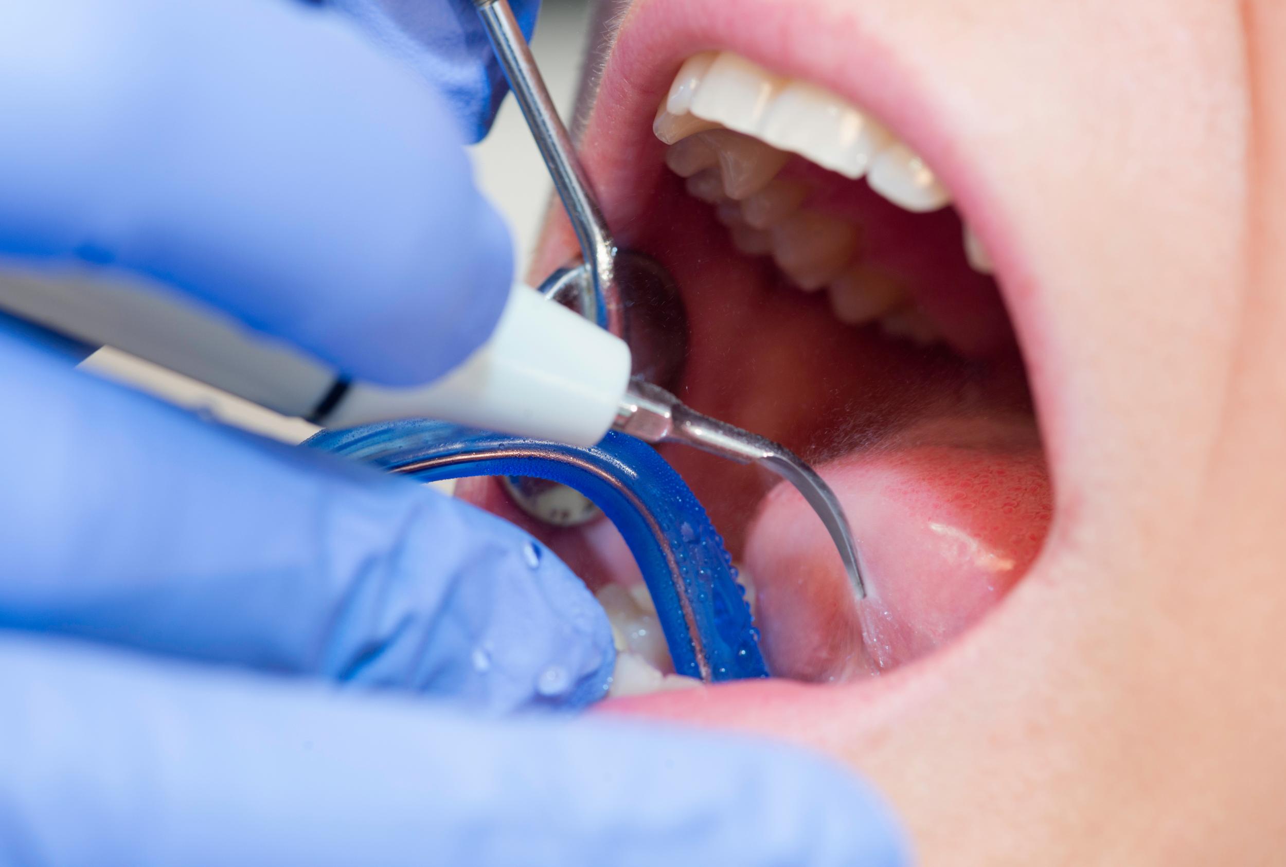 Endodontics – What It Is and What It Deals With