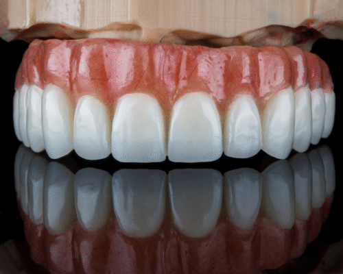 All on Four – A Revolutionary Solution for a Complete Smile in One Day