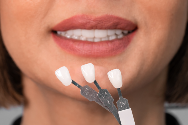 Zahnveneers für ein perfektes Lächeln!