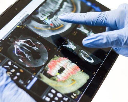 Endodoncija – liječenje kanala korijena zuba