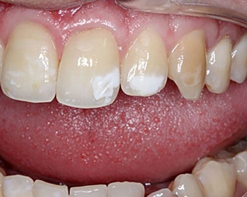 Why Do I Have White Spots on My Teeth?