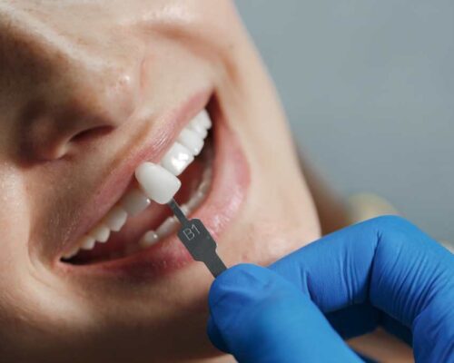 What is Dental Prosthetics and What Types Exist?