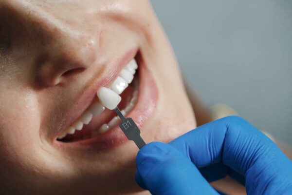 What is Dental Prosthetics and What Types Exist?