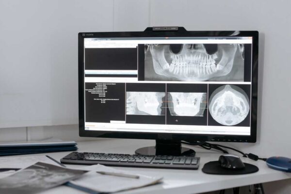 Kaj je CBCT 3D naprava v zobozdravstvu?