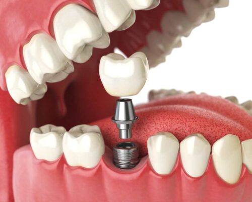 What are dental implants and how are they placed?