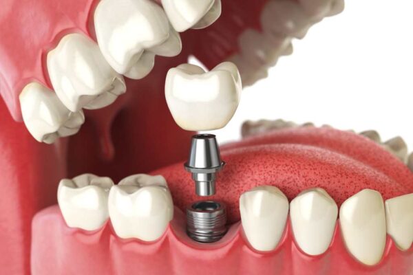 Cosa sono gli impianti dentali e come vengono inseriti?
