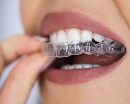 Medikadent aligners – Što su i kako se izrađuju?