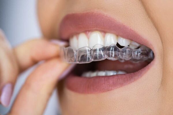 Medikadent aligners – Što su i kako se izrađuju?