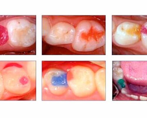 Fissure Sealants!