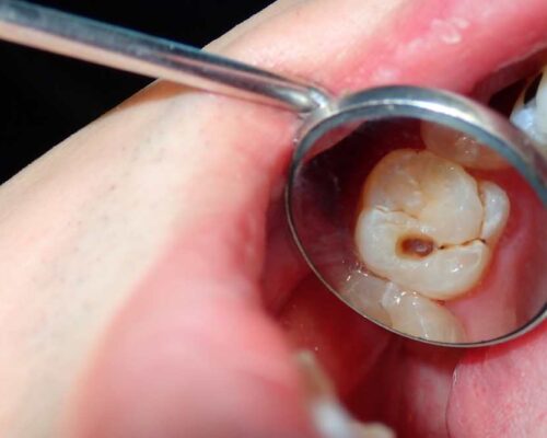 Endodontics – What It Is and What It Deals With
