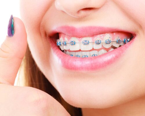 Orthodontics – Braces for Teeth