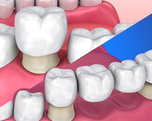 What Are Crowns and Bridges?