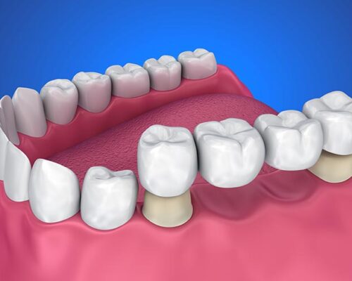 What Are Dental Bridges?