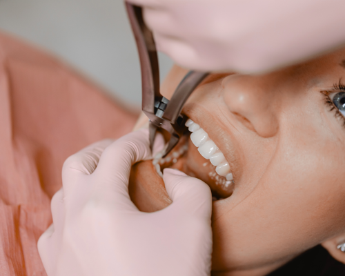 Tooth Extraction – Everything You Need to Know