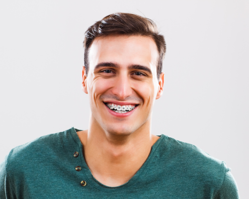 Sve što trebate znati o ortodonciji i aparatićima za zube