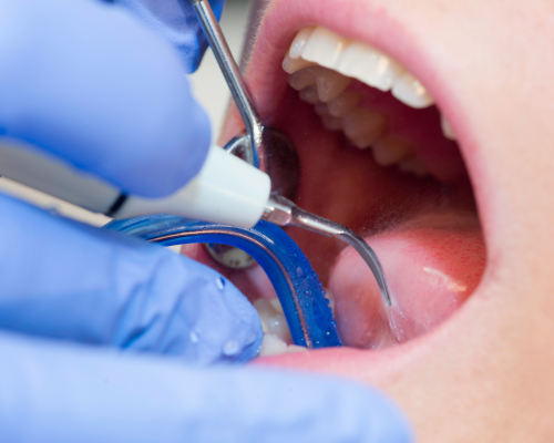 Endodoncija – Što je i čime se bavi?