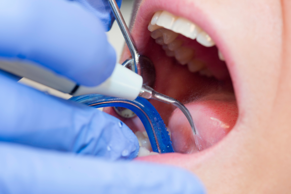 Endodoncija – Što je i čime se bavi?